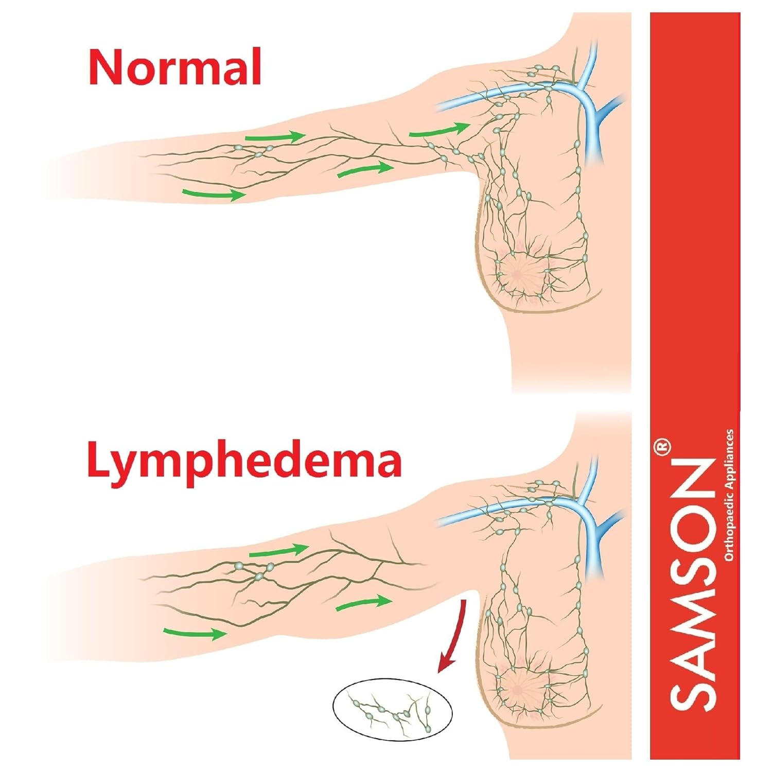 Lymphedema Arm Sleeve (Single) - Compression Stocking Recommended by Doctors, For Post-Mastecomy & Lymphoedema of Hand and Arm, Extra-Firm Graduated Compression (For Women & Men) - Image 6
